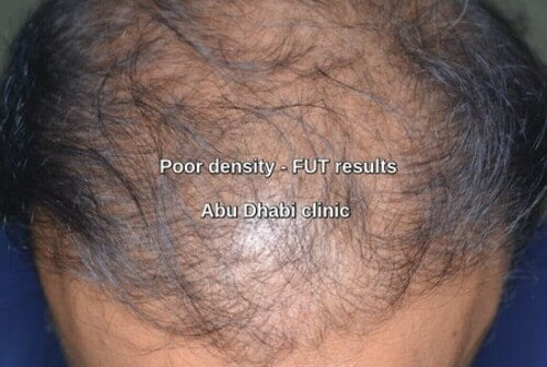 Hair transplant clinic Abu Dhabi patient repair abroad | contact us