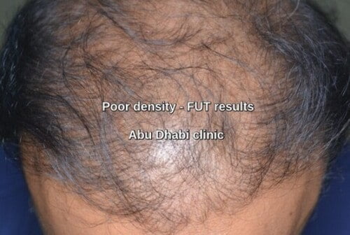 Hair transplant Abu Dhabi clinic Patient