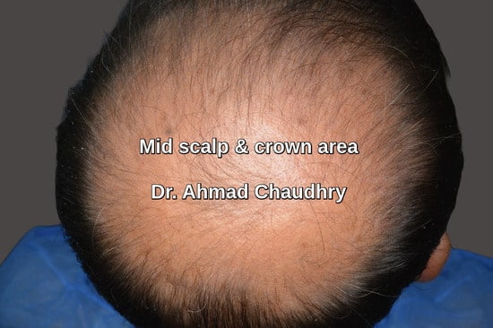 Hair transplant Abu Dhabi patient before