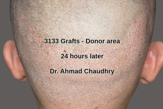 Hair transplant Sharaqpur patient