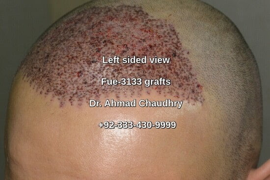 Left view 24 hours after Fue procedure