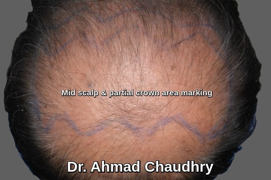 Hair transplant Abu Dhabi patient | Get free estimate | Contact now