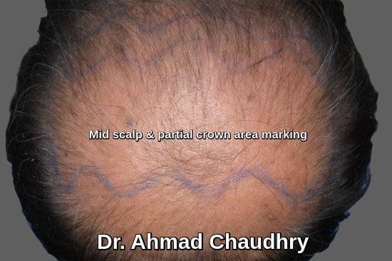 Mid scalp - crown area marking