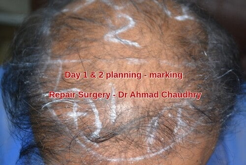 Repair hair restoration surgery planning