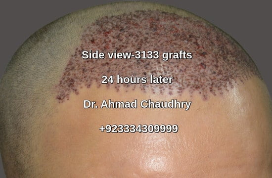 Right view-3133 grafts-Sharaqpur Sharif