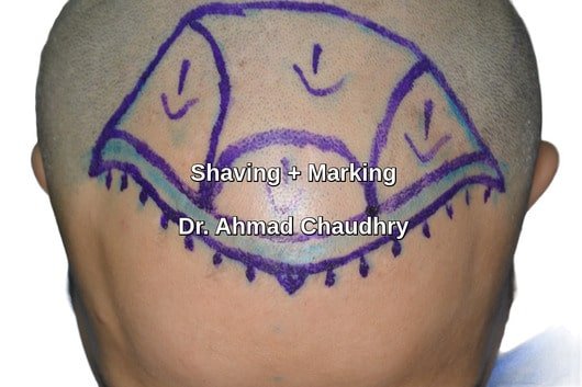shaving - marking before Fue