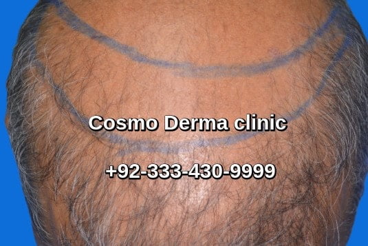 Hair transplant Toronto Canada