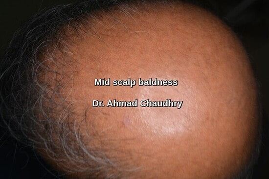Midscalp baldness Canada patient