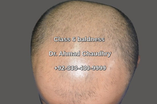 Before Baldness treatment