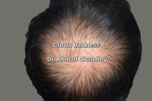 Crow hair transplant Manchester UK patient | 1938 grafts | abroad | contact