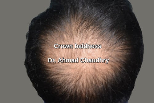 Crown baldness before