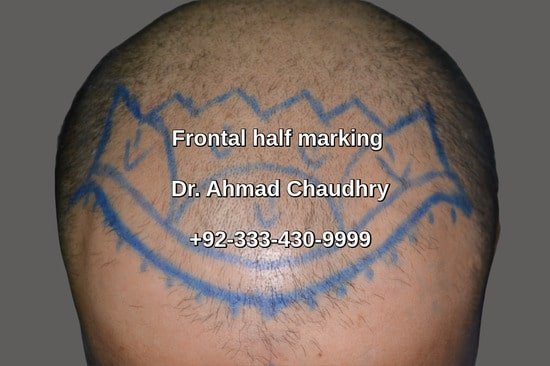 Frontal baldness marking