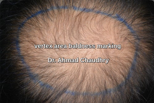 Vertex hair loss marking