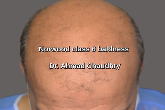 Advance baldness treatment
