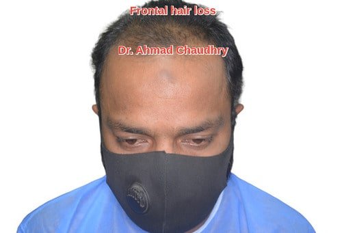 Baldness treatment Rahim Yar Khan patient