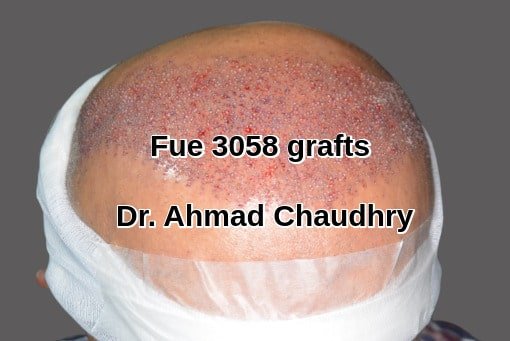 Best hair transplant Dubai