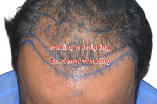 Designing before hair restoration RYK patient