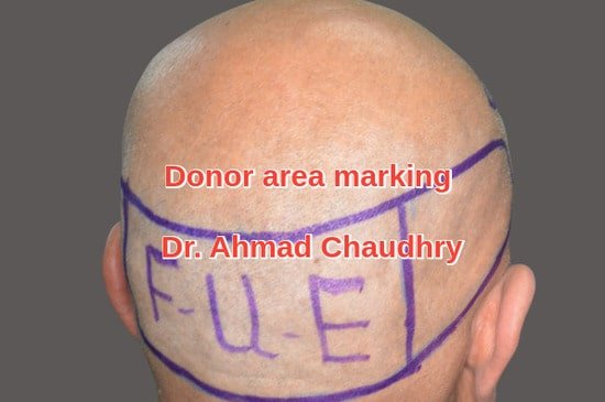 Donor area marking Dubai patient