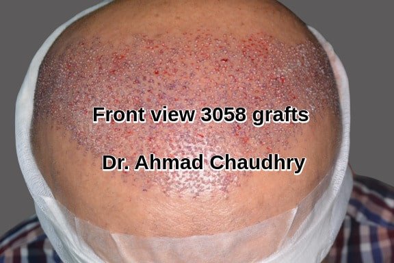 Fue 3058 grafts Dubai patient