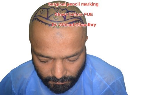 Fue hair transplant Sadiqabad patient