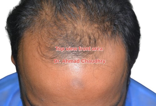 Top view hair loss front zones