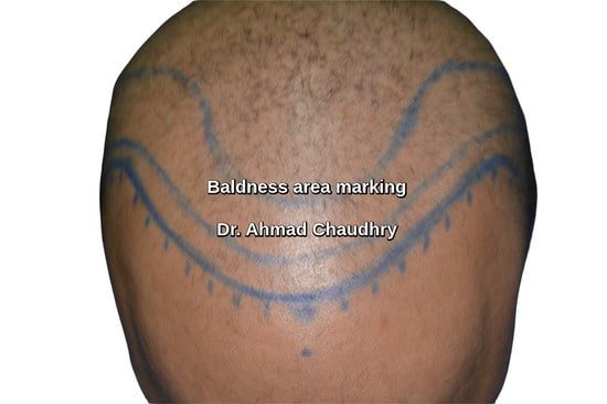 Baldness Karak patient