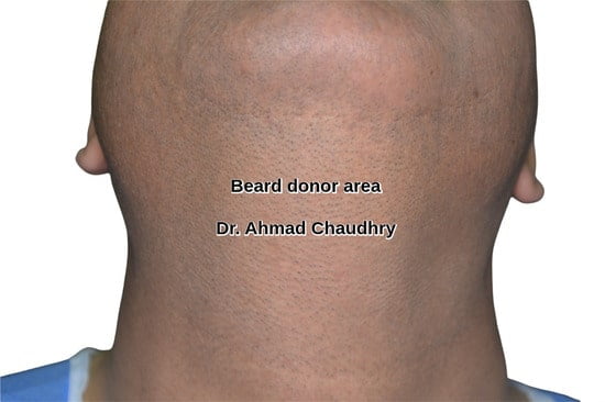 Beard donor area use Karak KPK patient