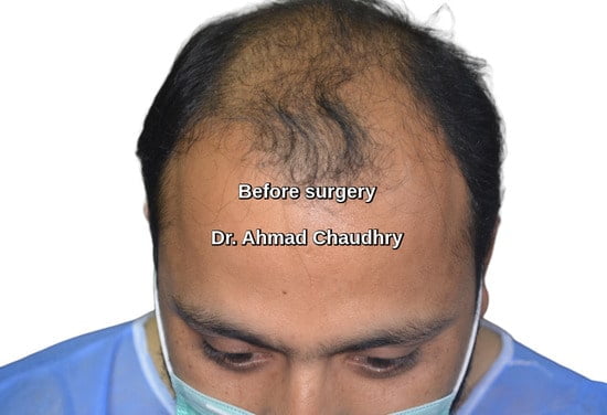 Hair loss Lahore Pakistan patient