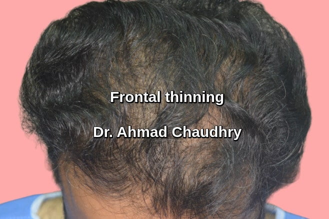 Hair loss treatment Doha patient