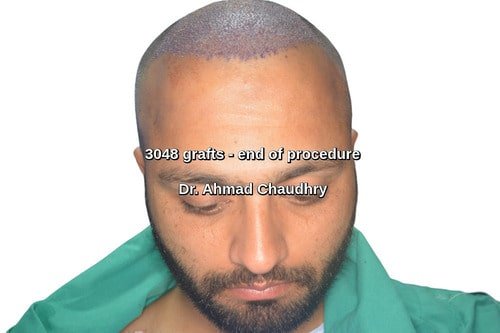 Hair transplant Lahore Pakistan patient