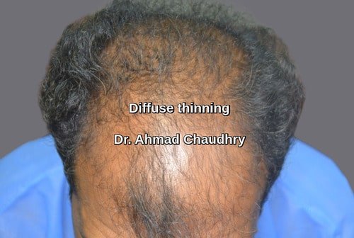 Hair transplant Pasrur