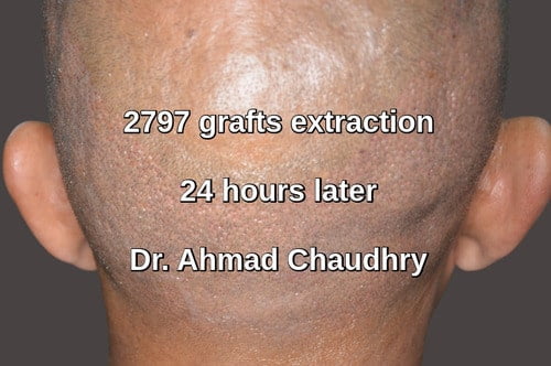 2797 grafts donor area extraction healing