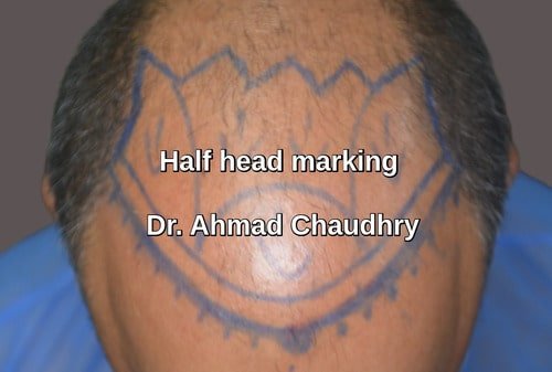 Baldness area marking before treatment