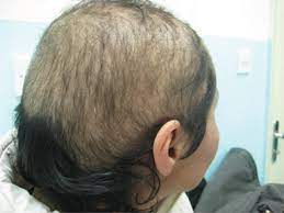 Children hair loss