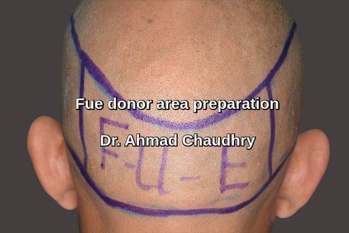 Donor area fue preparation