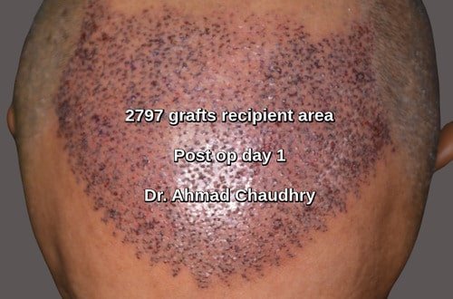 Fue 2797 grafts post op day one Faisalabad patient