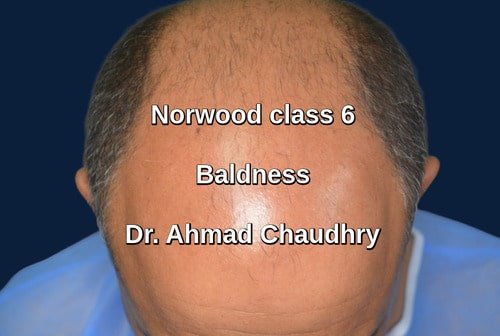 Fue hair transplant Faisalabad patient