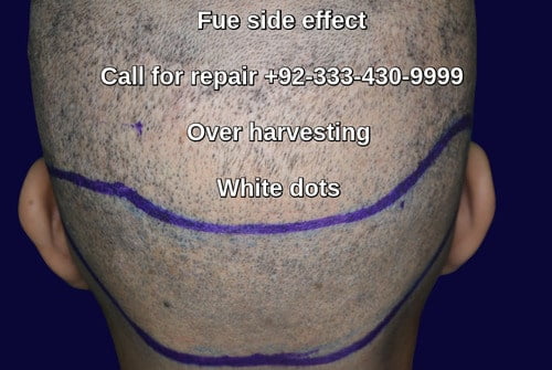 Fue hair transplant side effects