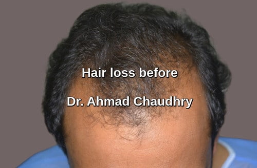 Hair transplant Burewala patient