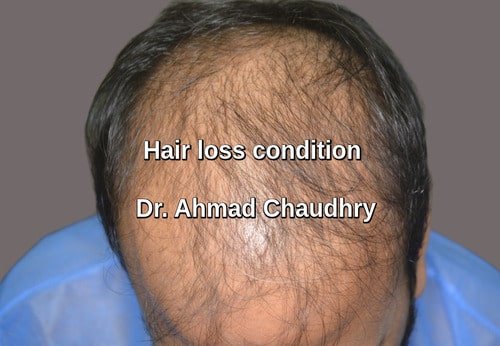 Hair transplant Walton Lahore