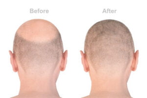 Cheapest hair transplantation Lahore Pakistan