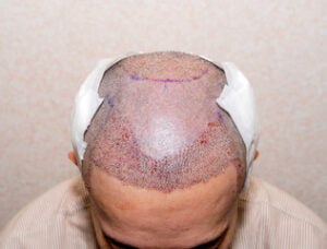 Hair transplant Shiraz cost