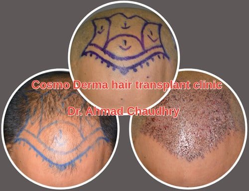 Hair loss hair transplant Bhakkar