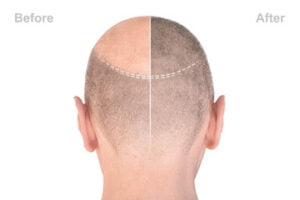 surgeries for hair loss Lahore