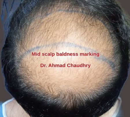 Baldness treatment through hair restoration Abu Dhabi patient