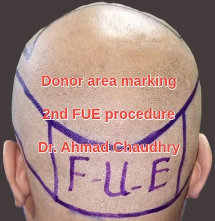 Donor area marking grafts extraction