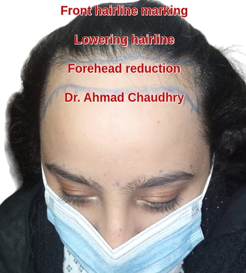 Female hair transplant Lahore