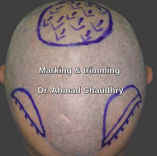 Hair transplant Abbottabad