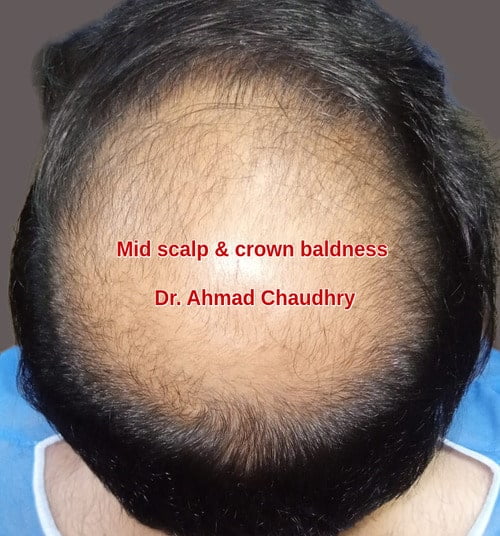 Mid scalp area baldness treatment