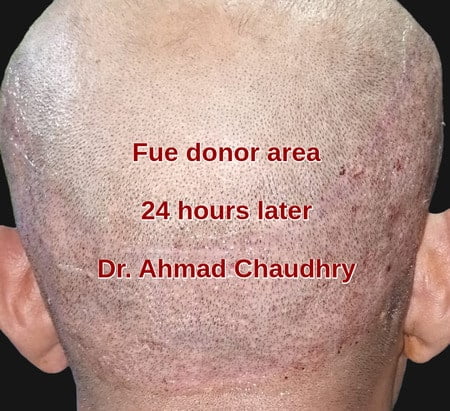 2500 Fue donor pictures